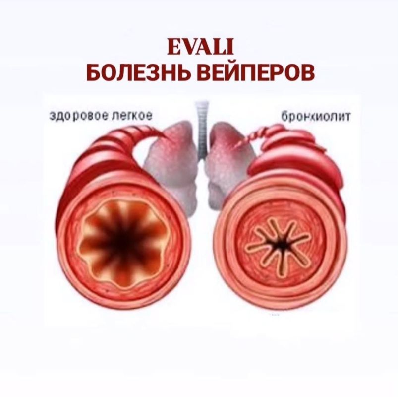 EVALI — болезнь вейперов и любителей электронных сигарет